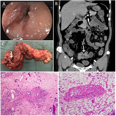 Idiopathic Myointimal Hyperplasia of the Mesenteric Veins: A Case Report and Scoping Review of Previously Reported Cases From Clinical Features to Treatment